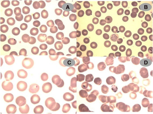 Malaria Parasite In Red Blood Cells, Ring Form Stage Of Plasmodium  Falciparum, Original Magnification 1000x Stock Photo, Picture and Royalty  Free Image. Image 170216304.